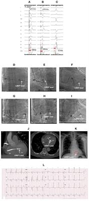 Procedure-Related Complications of Left Bundle Branch Pacing: A Single-Center Experience